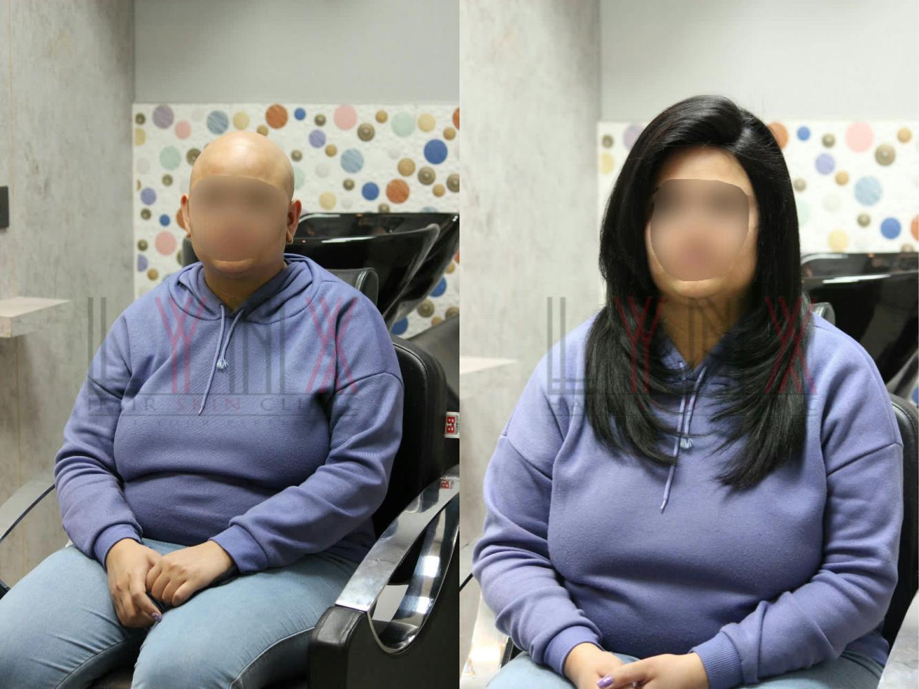 Lynx Hair Studio Hyderabad Wigs for Cancer patients in Hyderabad