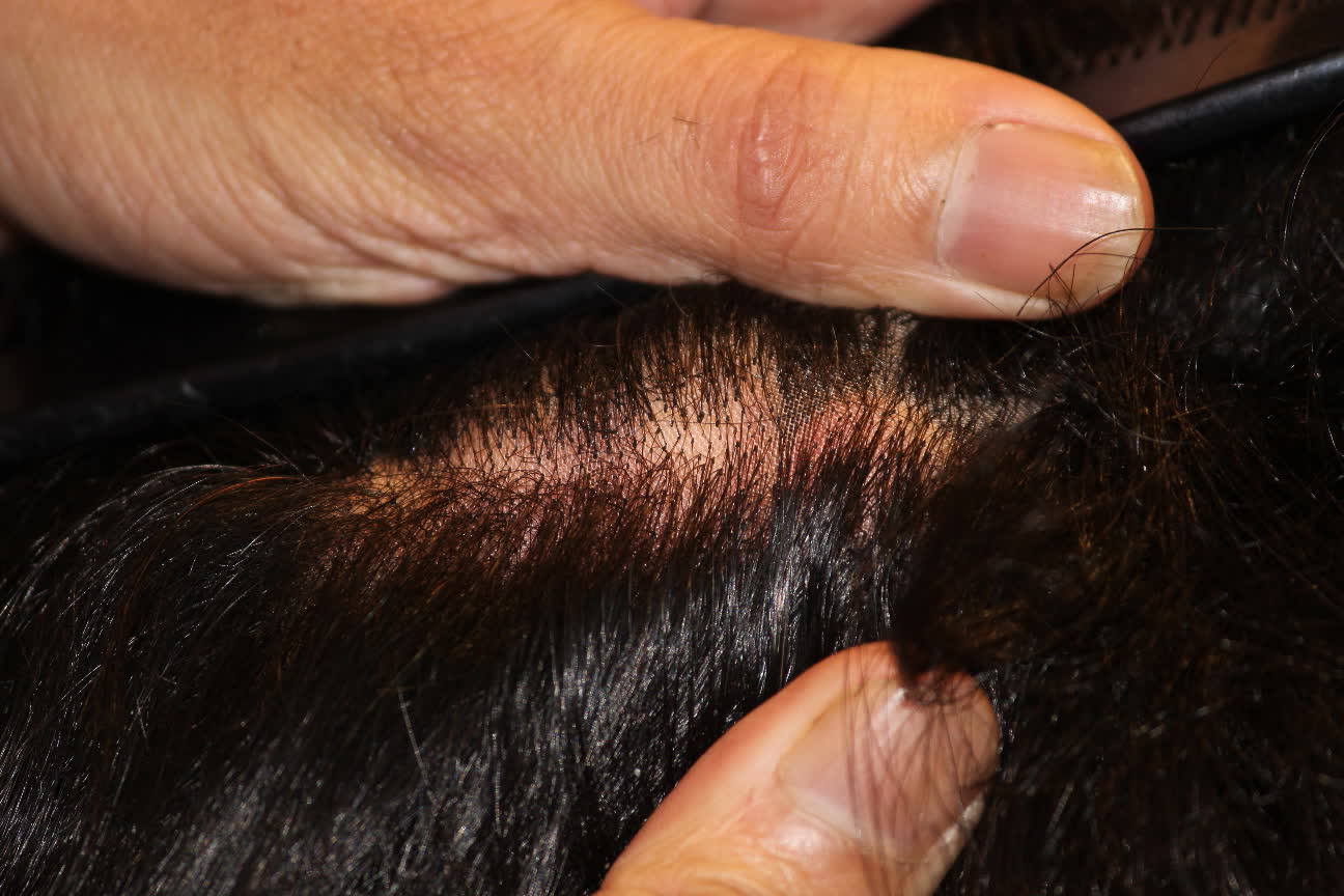 Prem Hair Expert LYNX Jaipur Gent's Hair Wigs in Jaipur