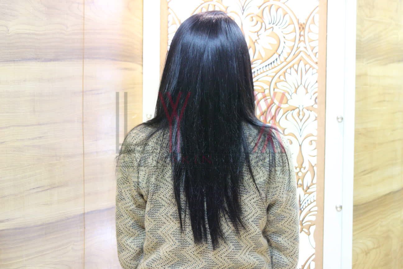 Prem Hair Expert LYNX Jaipur Wigs for Cancer patients in Jaipur